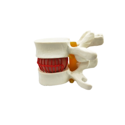 Фото: Анатомическая модель грыжи поясничного диска человека Corpo de Hernia-2 Анатомическая модель грыжи поясничного диска человека Corpo de Hernia-2